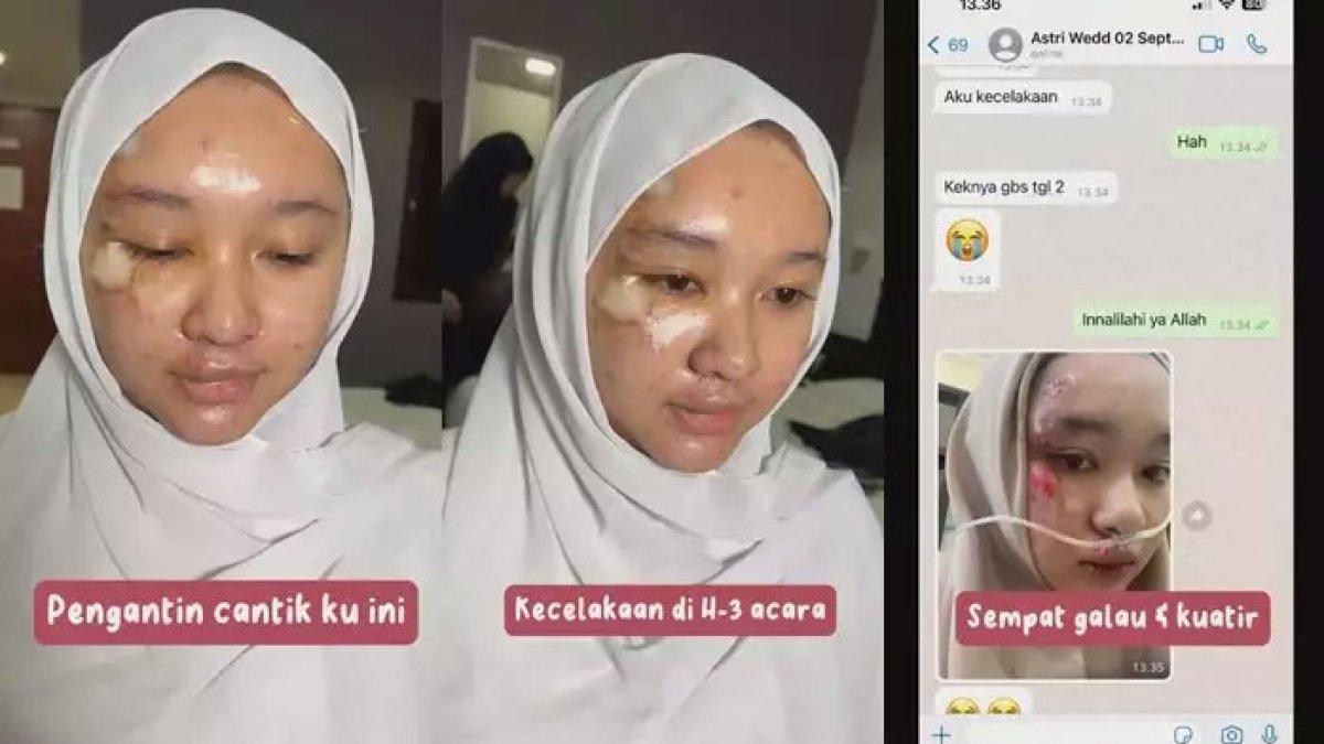 Calon pengantin kecelakaan jelang hari nikahan, untung bisa ditutup make up