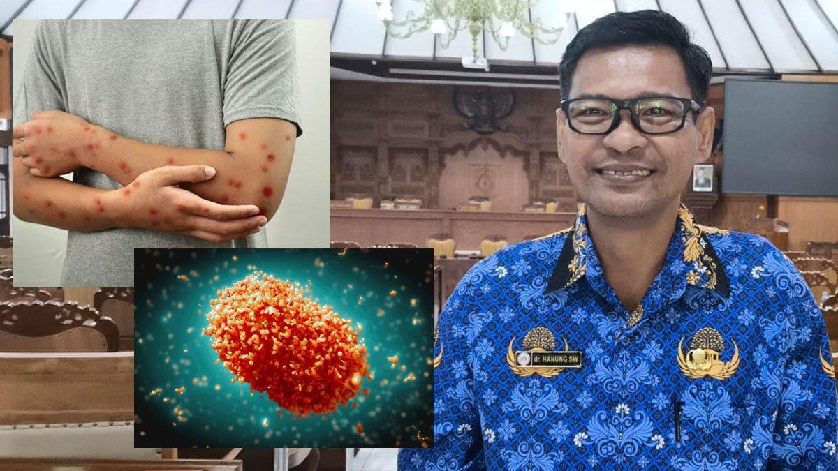 Dinkes Kabupaten Klaten menjelaskan soal Mpox