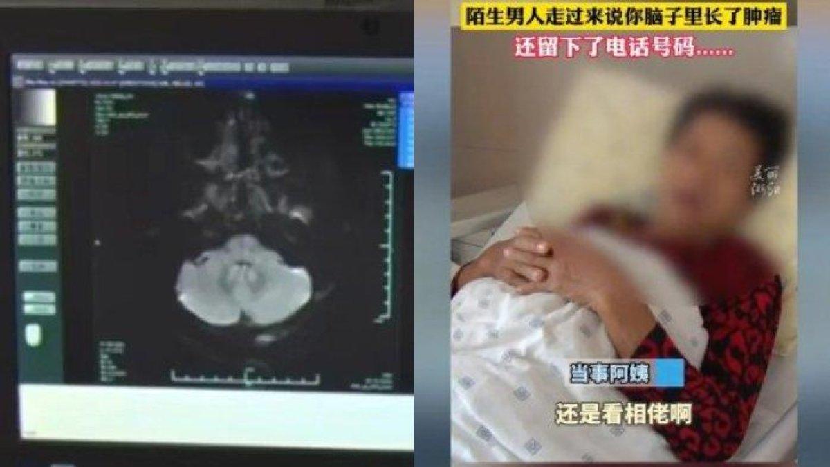 Dokter di China temukan gejala tumor otak pada seorang wanita di restoran b