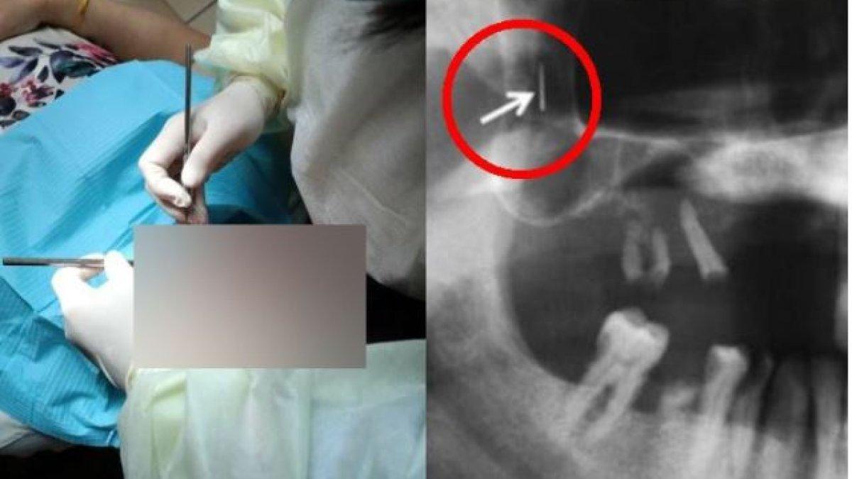 Dokter temukan susuk pemikat di wajah pasiennya (2)