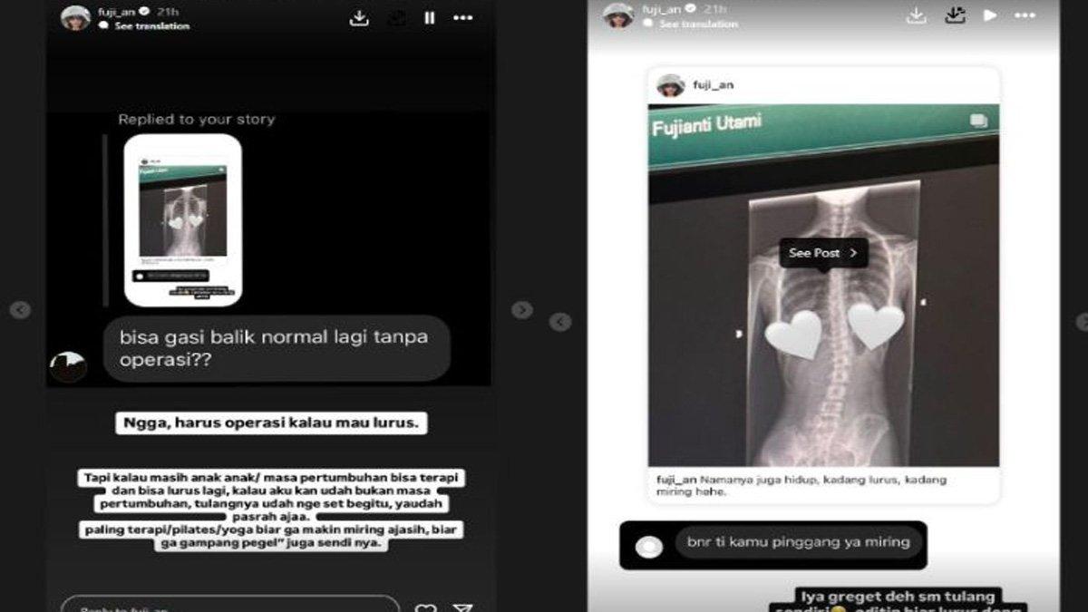 Fuji pamer hasil rontgen tulang belakangnya yang alami skoliosis