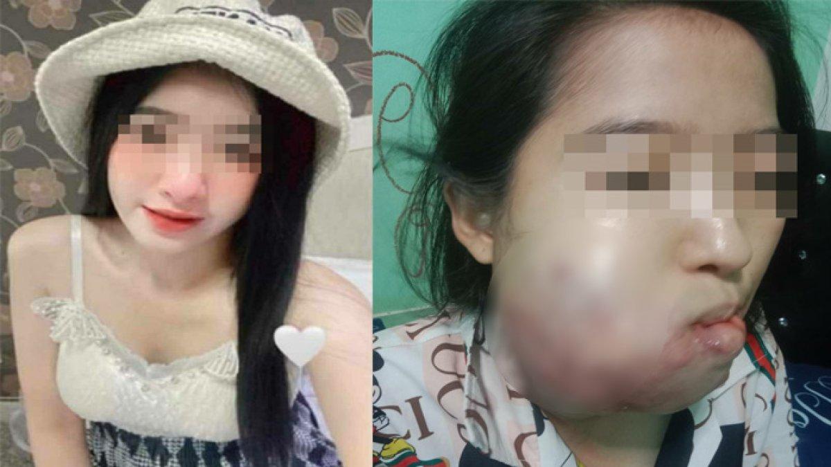 Gadis kehilangan nyawa setelah operasi gigi, pipi bengkak a