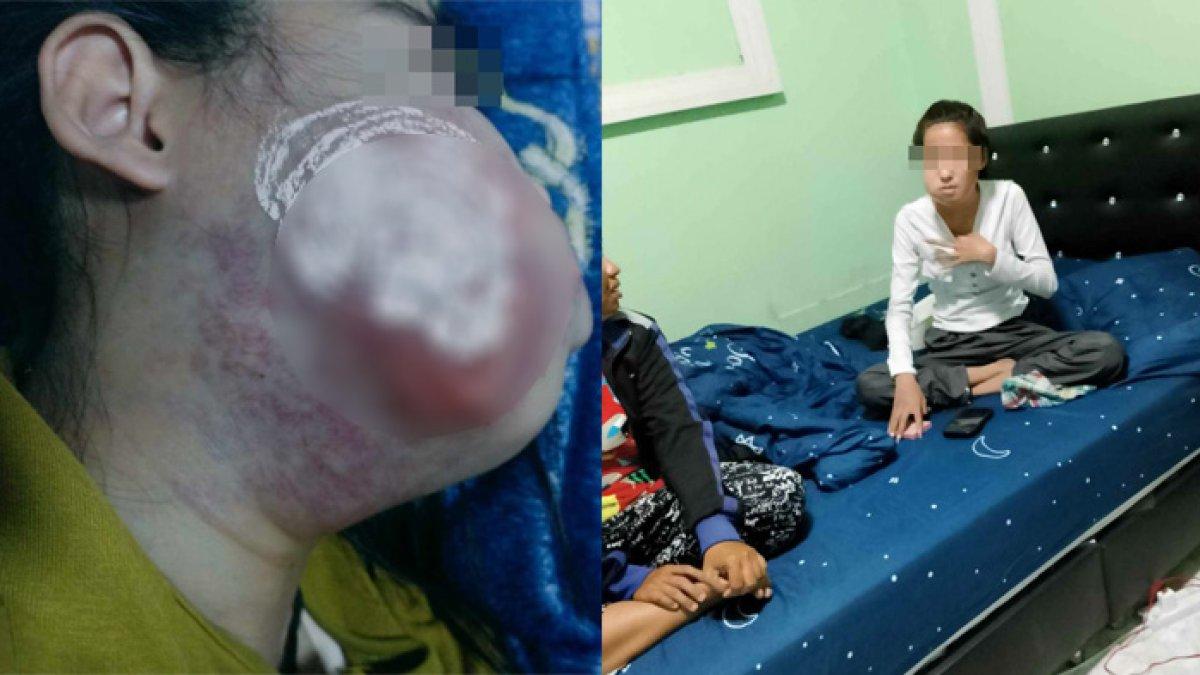 Gadis kehilangan nyawa setelah operasi gigi, pipi bengkak