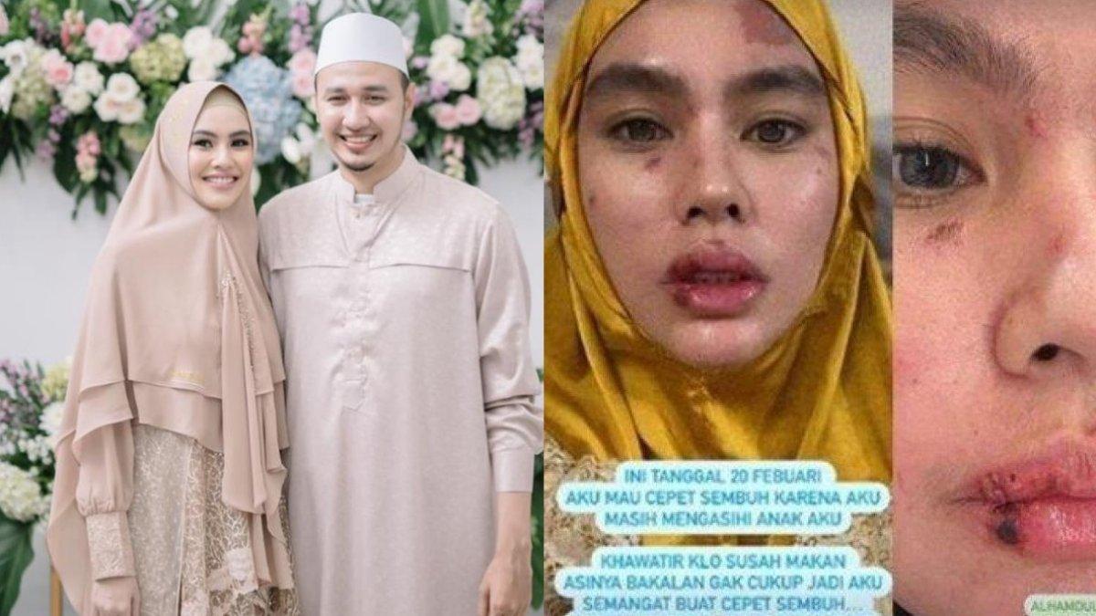 Habib Usman bela Kartika Putri yang disebut kena azab hingga wajahnya melepuh