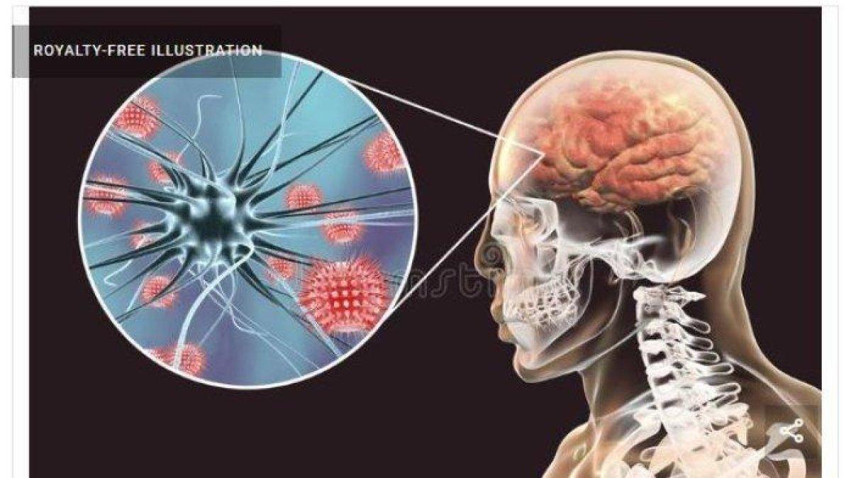 Ilustrasi penderita meningitis diakibatkan bakteri meningokokus. // Neisseria meningitidis yang diakibatkan bakteri meningokokus, adalah bakteri gram-negatif penyebab penyakit meningitis, meningokokus dan meningococcemia. 