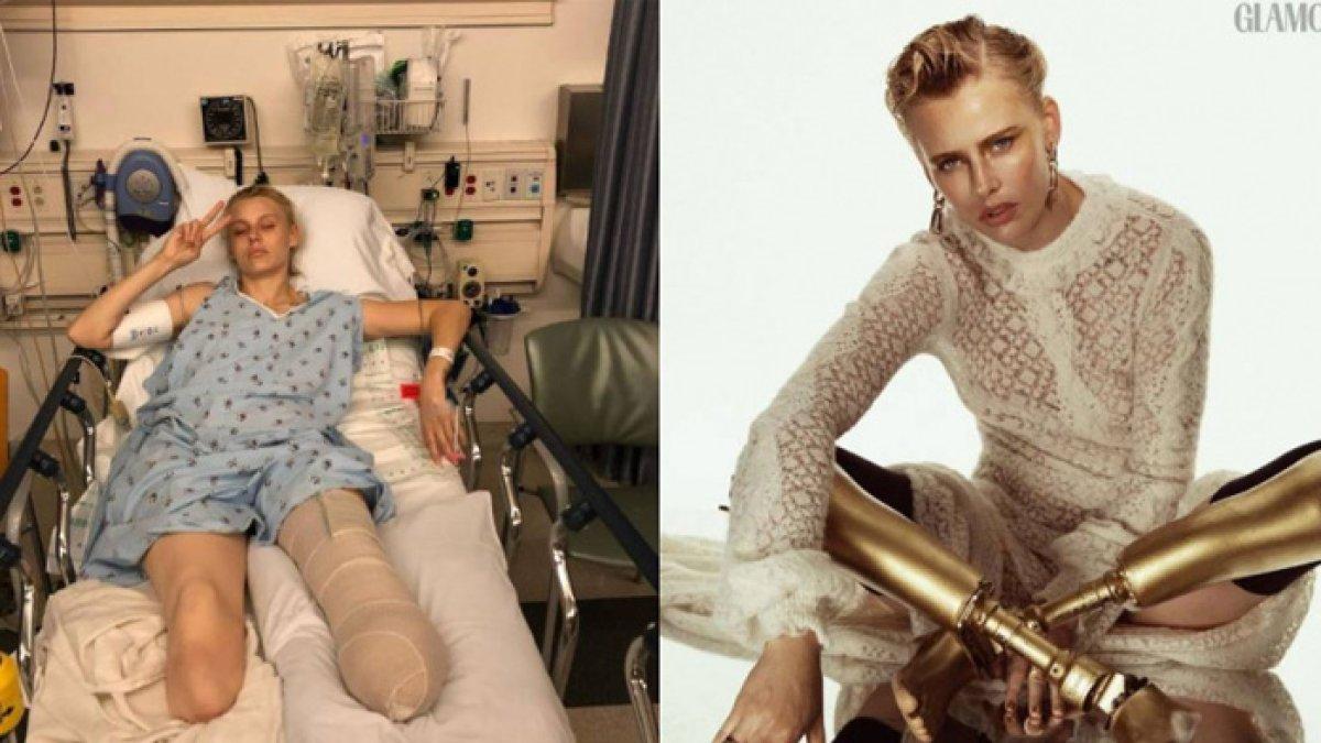 Kaki model ini diamputasi gegara pembalut atau tampon a