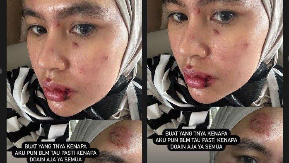 Kartika Putri membagikan kesedihannya atas kondisi wajah dan lidahnya yang melepuh tanpa sebab (instagram/kartikaputriworld)
