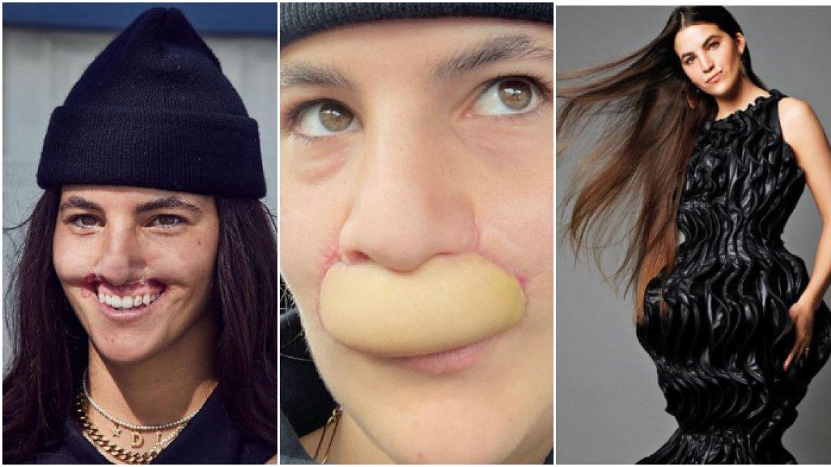 3 Tahun Lalu Bibirnya Remuk Digigit Anjing, Model Ini Cantik Lagi Usai