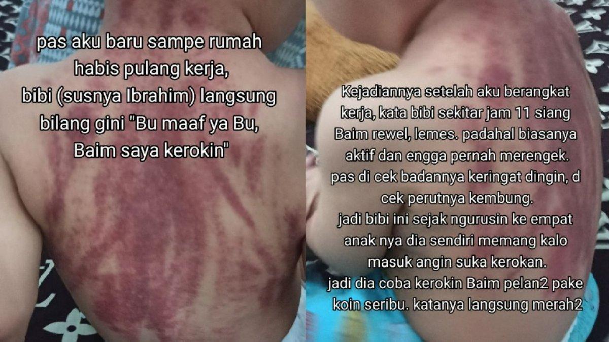 Kondisi rubuh bayi yang dikeroki pengasuhnya