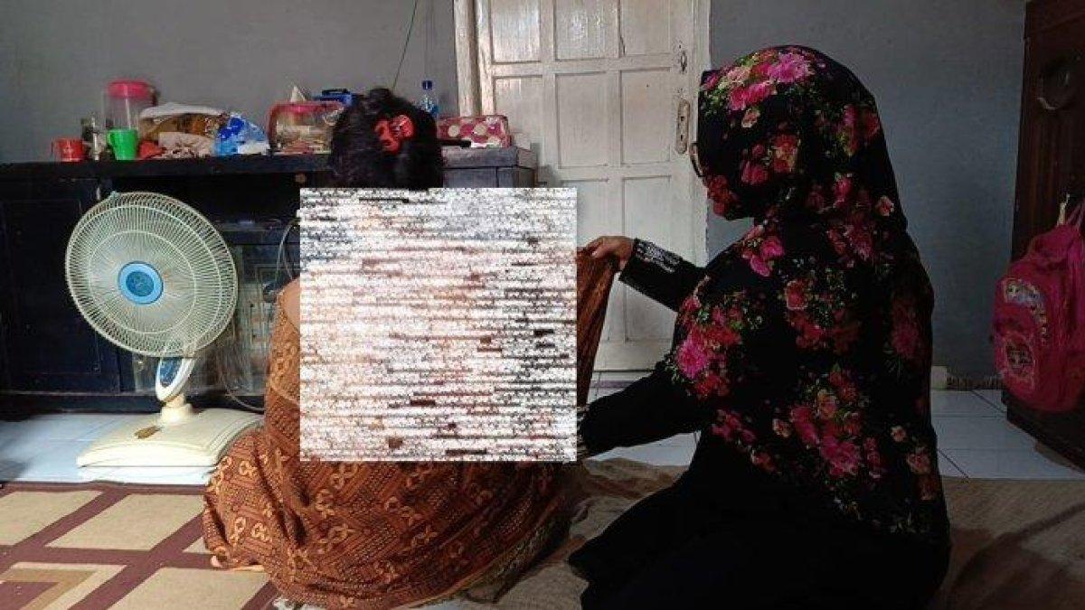 Korban mengalami luka melepuh di pundak dan wajahnya usai disiram sang suami, Jumat (19/1/2024)