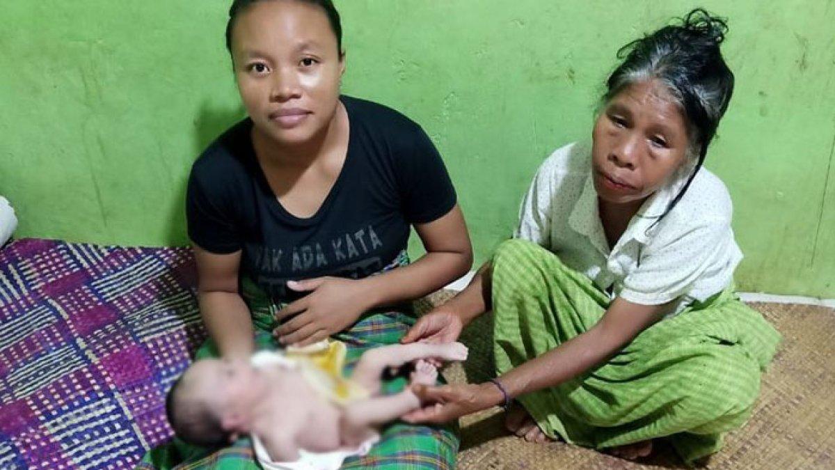 Marselino Tasman bayi berusia 48 hari asal Desa Compang Cibal, Kecamatan Cibal Barat, Kabupaten Manggarai, Nusa Tenggara Timur (NTT) lahir tanpa lubang anus.
