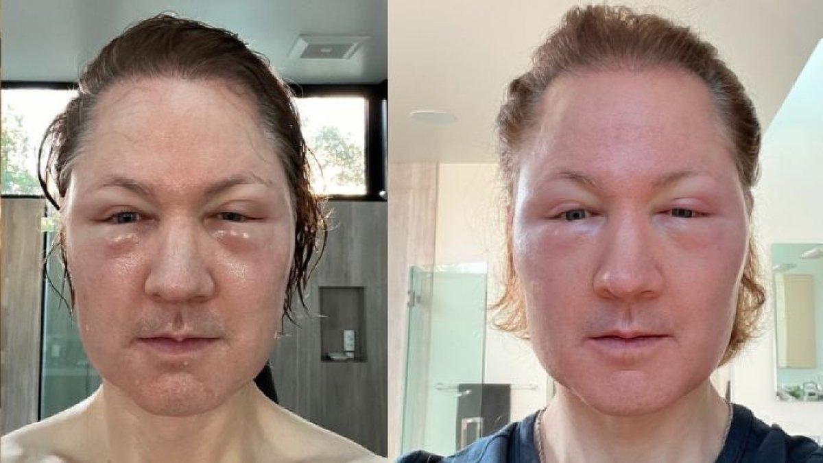 Miliarder Suntik Lemak di Wajah Demi Awet Muda, Hasil Malah Mengerikan