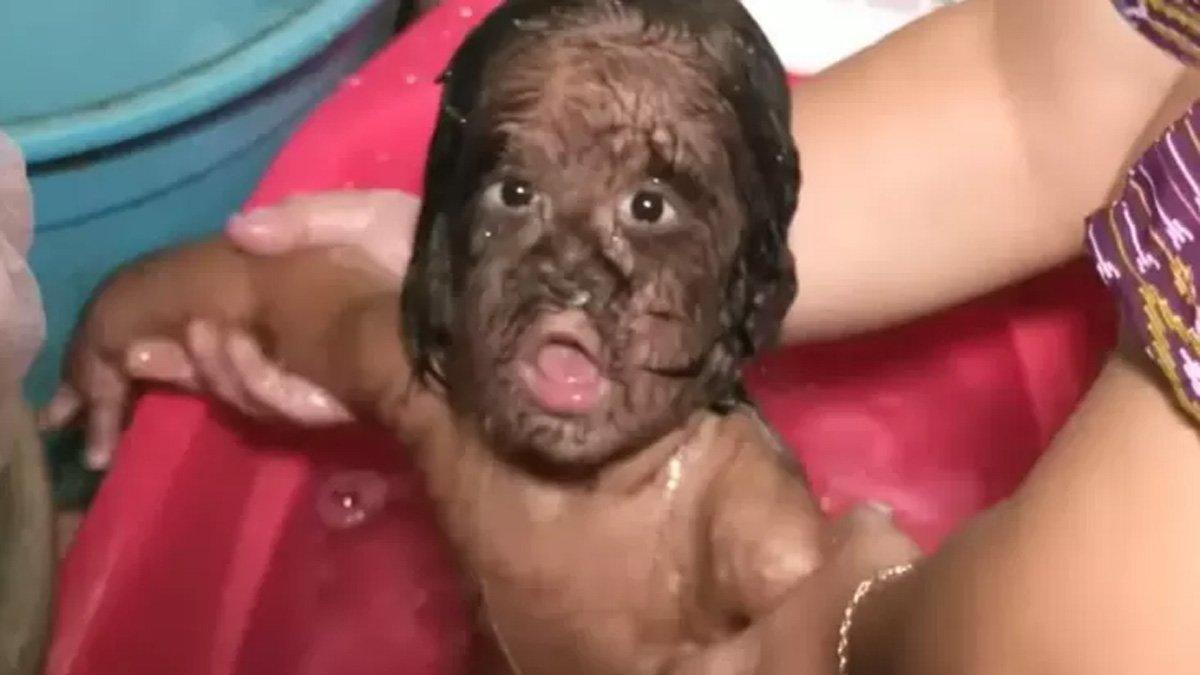 Missclyen alami sindrom Serigala menyebabkan pertumbuhan rambut di bagian wajah berlebihan.