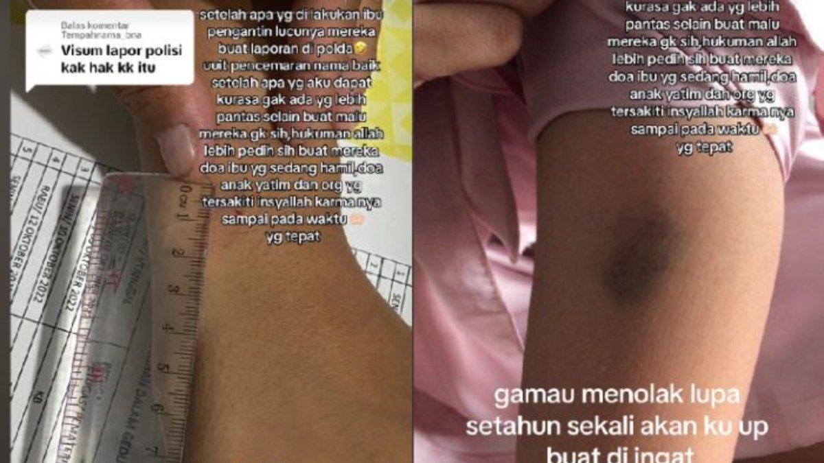 Nabilla alami luka memar saat menagih uang pelunasan jasanya.