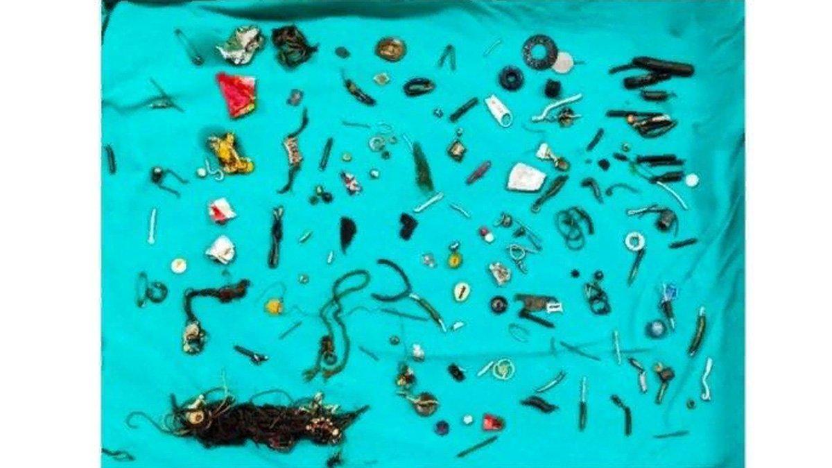 Penampakan 150 benda di usus Kuldeep Singh.