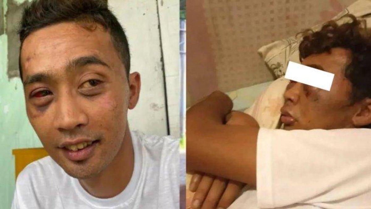 Pengamen Keterbelakangan Mental Dikencingi dan Dipukul hingga Babak Belur, Mata Bengkak