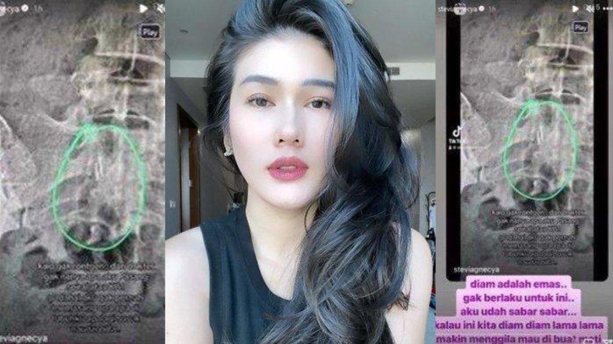 Penjelasan dokter soal benda misterius di pinggul Stevie Agnecya, foto rontgen-nya viral setelah almarhumah curhat kena guna-guna.