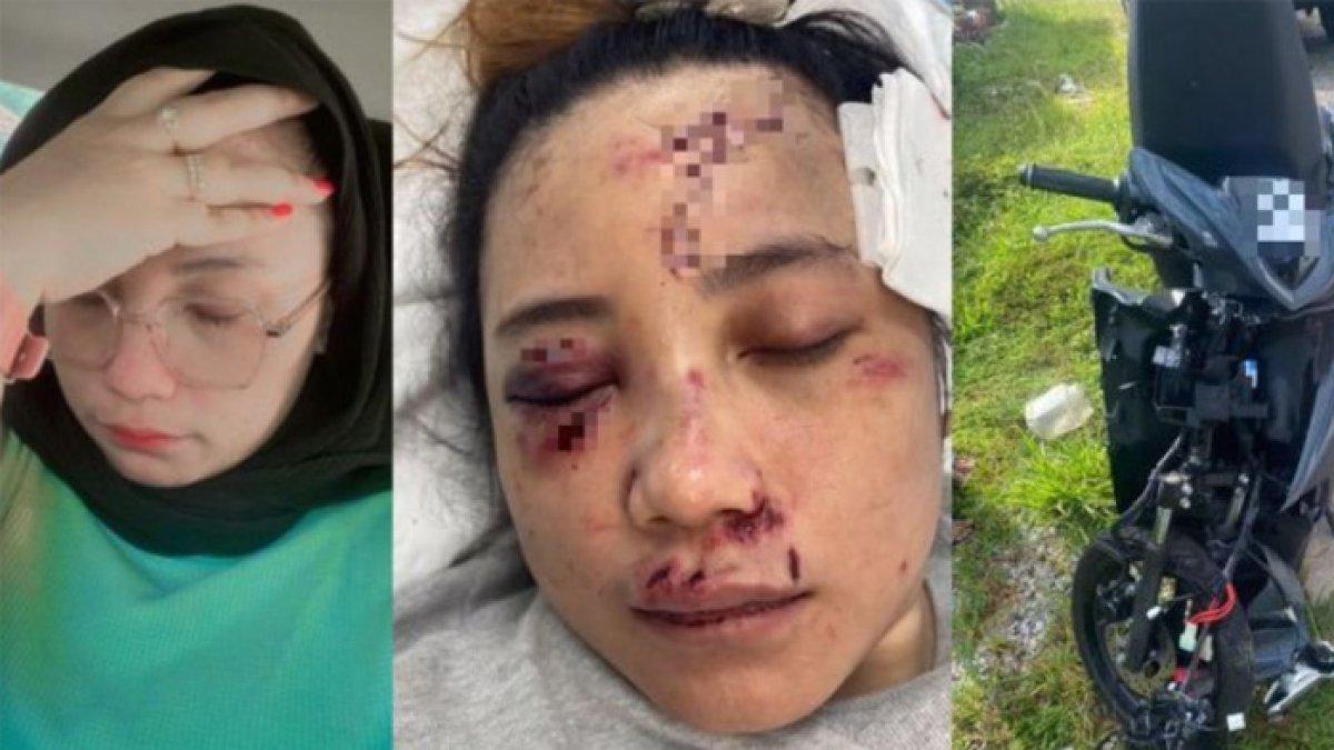 Wanita bernama Effa asal Malaysia kecelakaan malah ditinggal tunangannya.