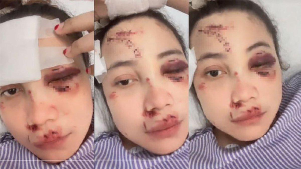 Pilu Effa, kecelakaan malah ditinggal tunangannya