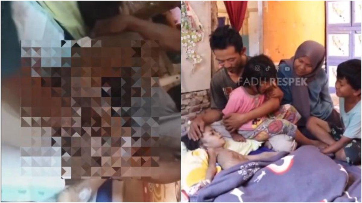 Reyhan yang masih berusia 8 tahun idap tumor ganas, tubuh kurus tinggal tulang.