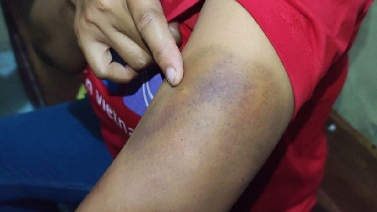 SY menunjukan luka memar di tangan kiri korban KDRT yang dilakukan Hudi suaminya sendiri, saat memberikan keterangan di Mapolsek Gegesik, Selasa (21/11/2023)