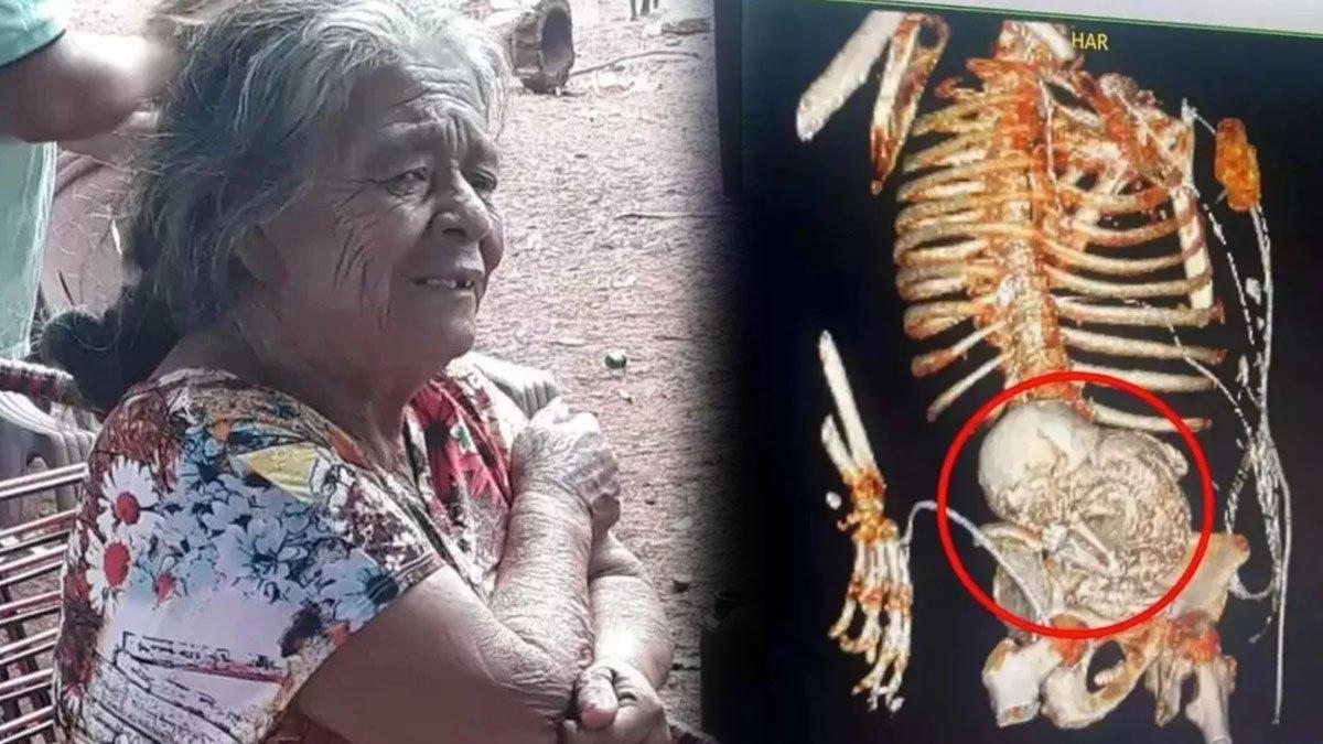 Seorang nenek berusia 81 tahun terkejut mengetahui ada janin membatu di perutnya se
