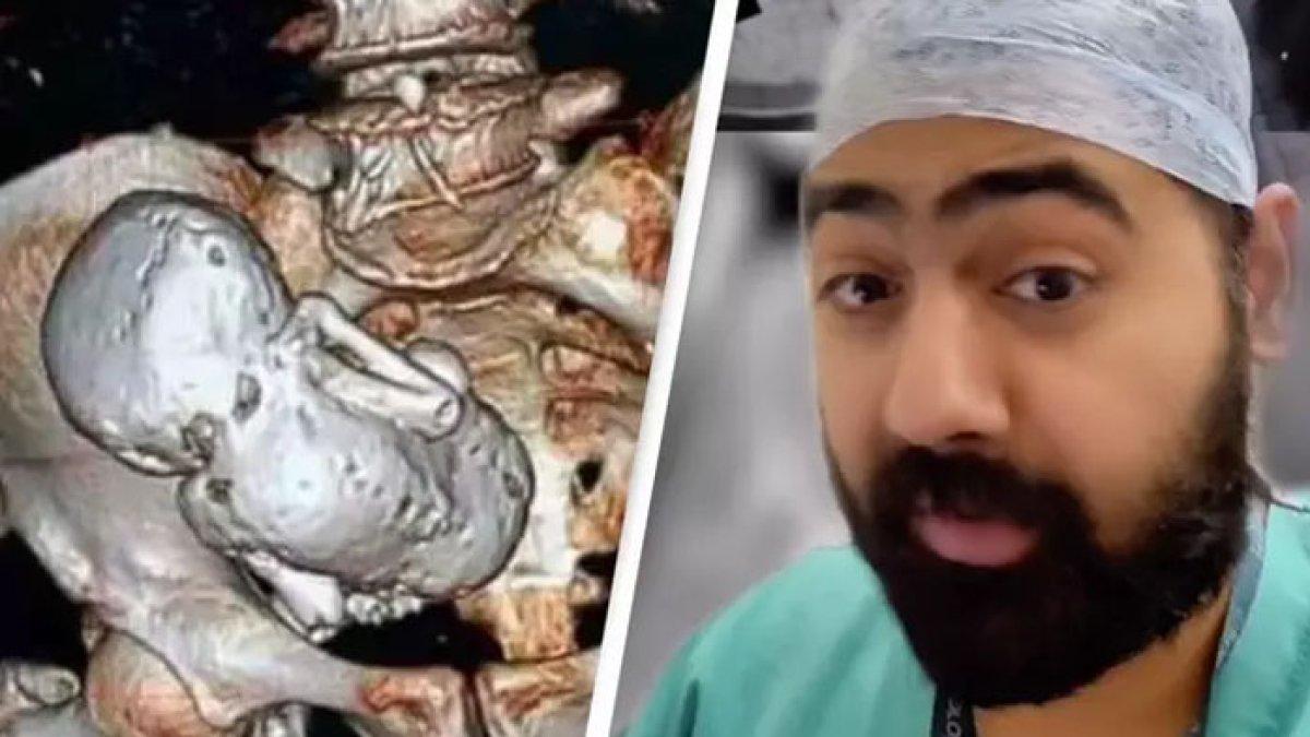 Seorang nenek mengeluhkan sakit perut yang sangat hebat, setelah periksa dirinya dan dokter syok menemukan ada bayi membatu di dalam perut