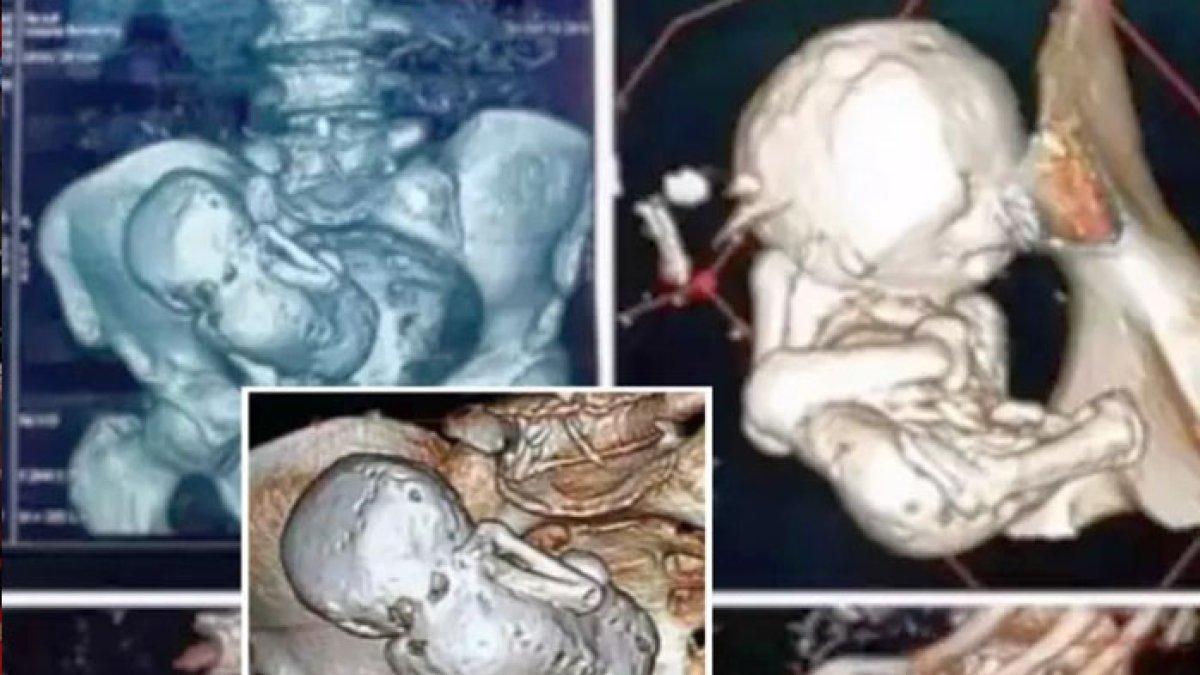 Seorang nenek mengeluhkan sakit perut yang sangat hebat, setelah periksa dirinya dan dokter syok menemukan ada bayi membatu di dalam perut