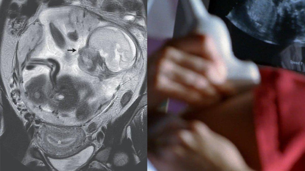 Seorang wanita syok ketika periksa ke dokter setelah mengeluh sakit perut, ternyata sedang hamil enam bulan