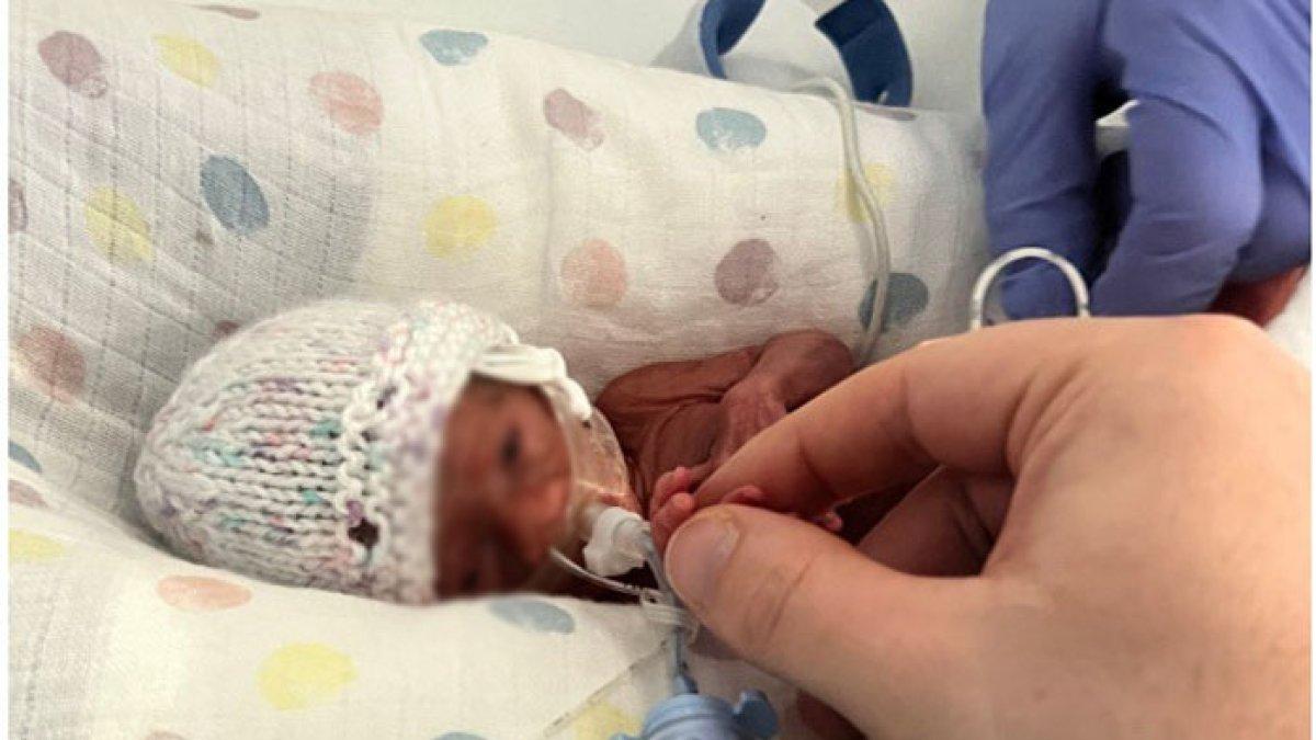 Seperti keajaiban, bayi mungil ini lahir hanya memiliki berat badan 400 gram, ajaibnya bisa lolos dari maut dan tumbuh sehat.