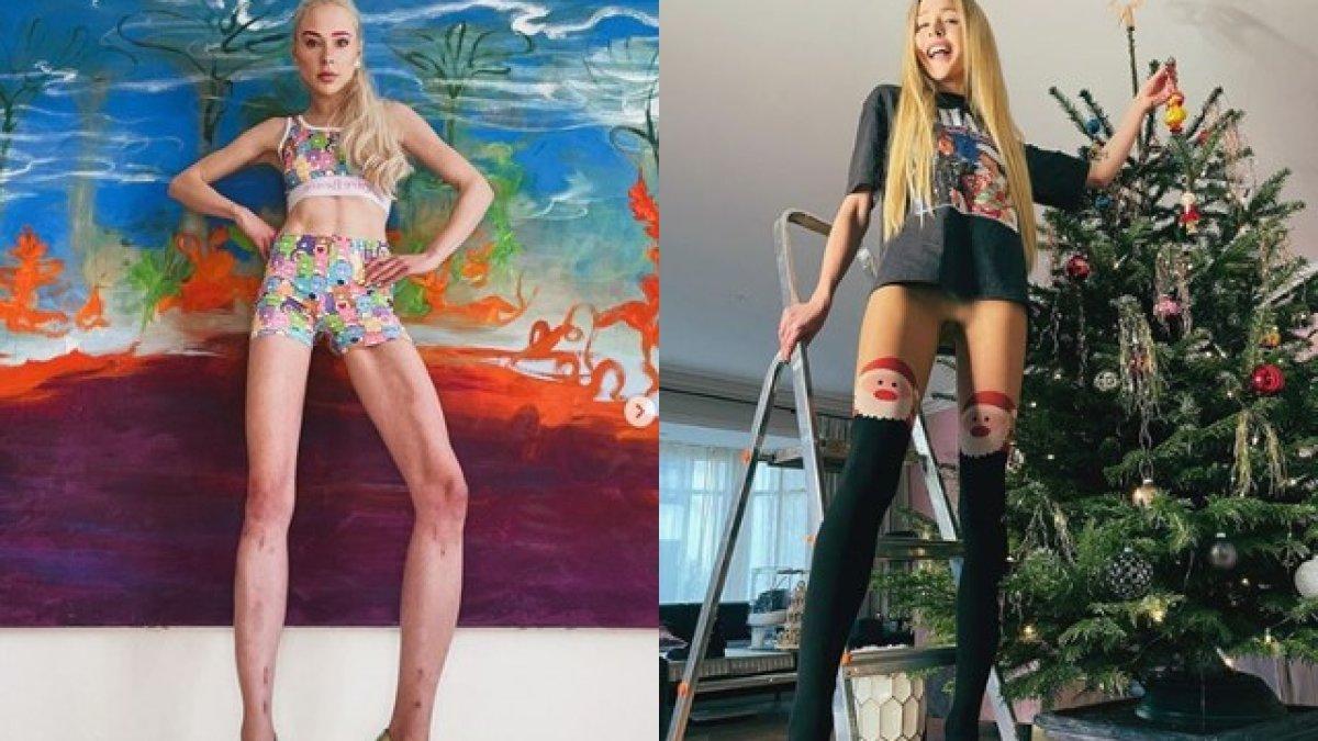 Theresia rela lakukan operasi pemanjangan kaki demi sang suami