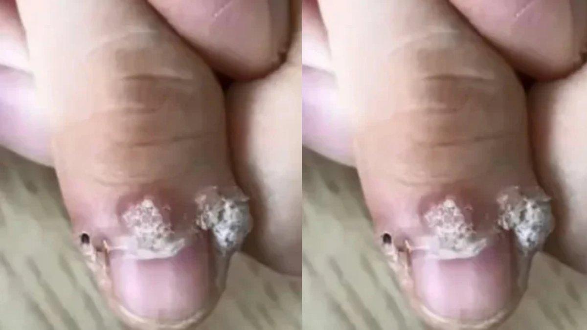 Viral jari wanita ini timbul benjolan setelah manikur.
