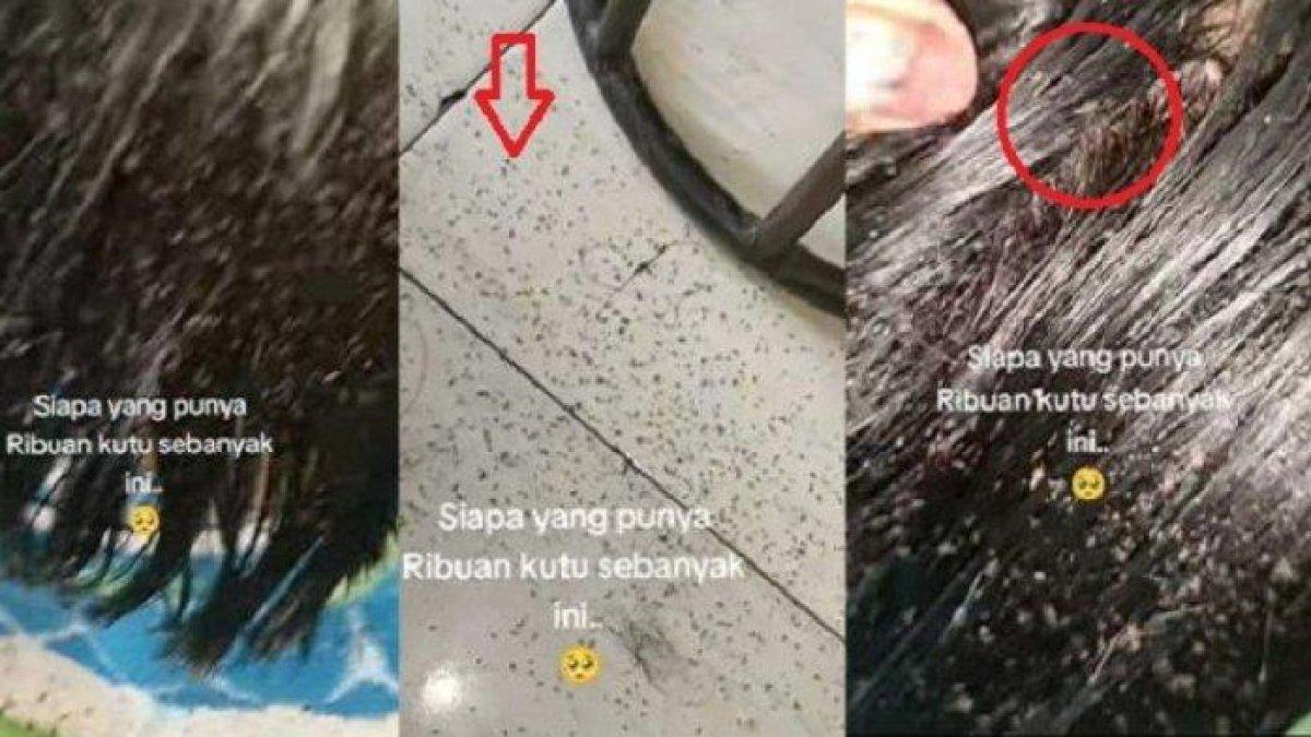 Viral ribuan kutu bersarang di rambut bocah ini