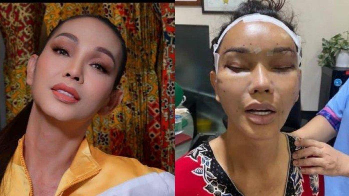 Bunda Corla jalani operasi plastik