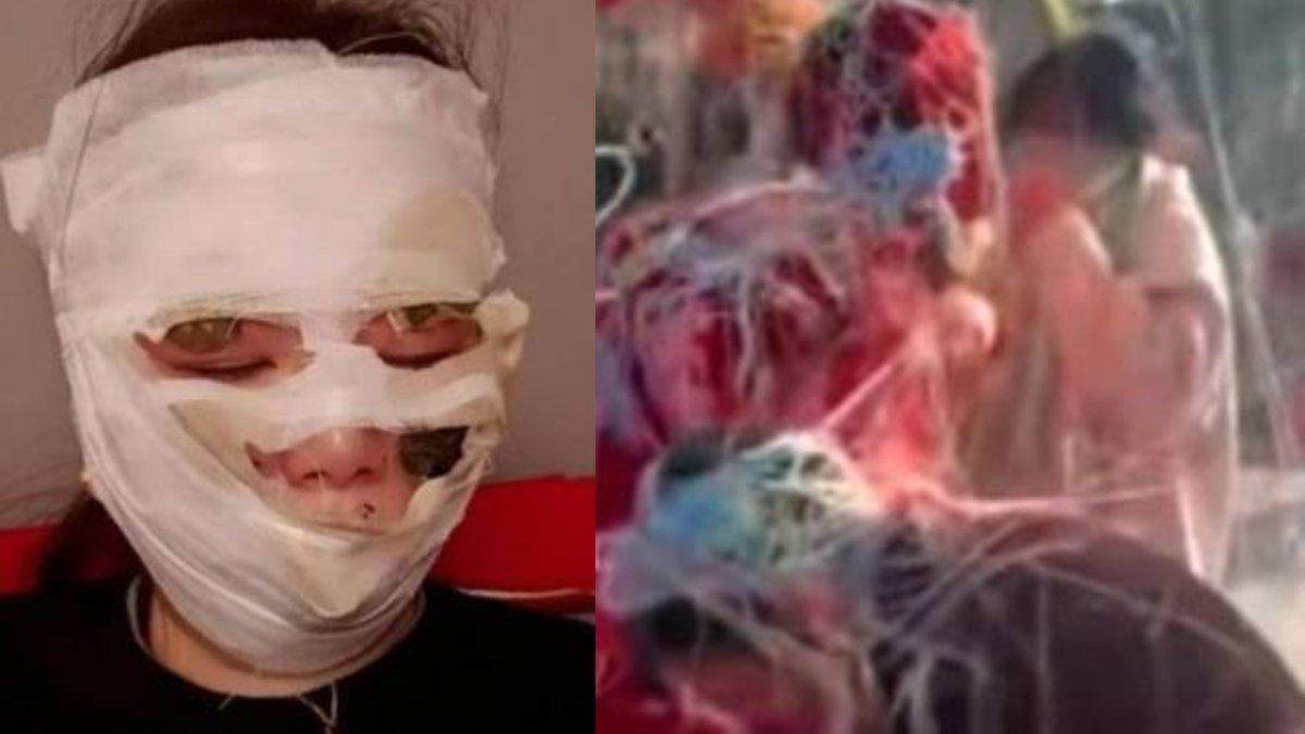 Wajah pengantin wanita terbakar gara-gara benda yang dipakai saat resepsi.