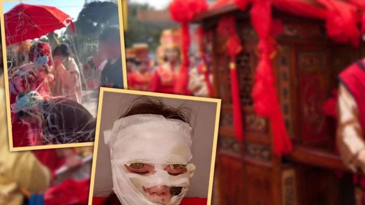 Wajah pengantin wanita terbakar gara-gara benda yang dipakai saat resepsi.