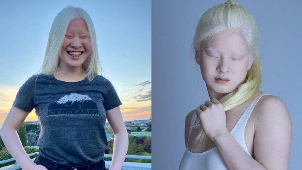 Xueli, gadis albino dibuang ke panti asuhan, kini jadi model terkenal