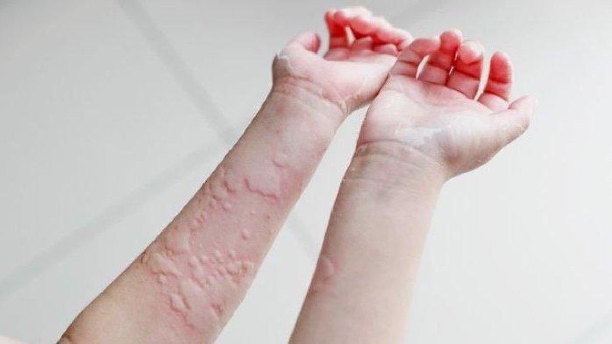 5 cara mengatasi alergi dingin secara alami dengan bahan dapur