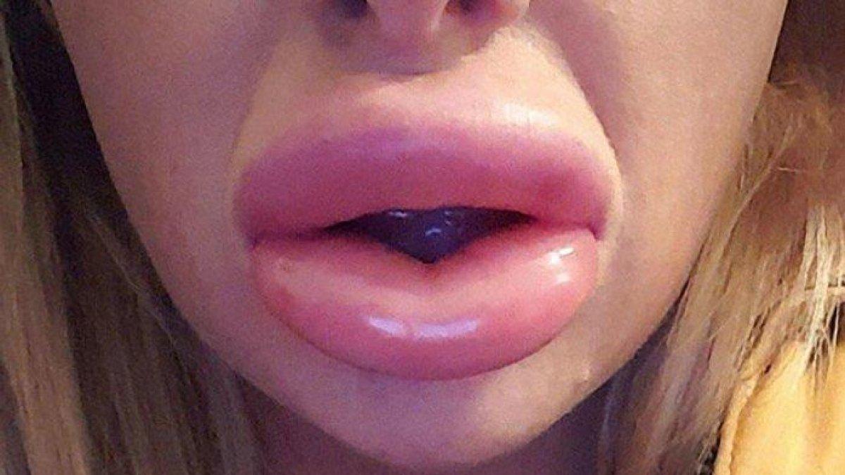 bibir bengkak