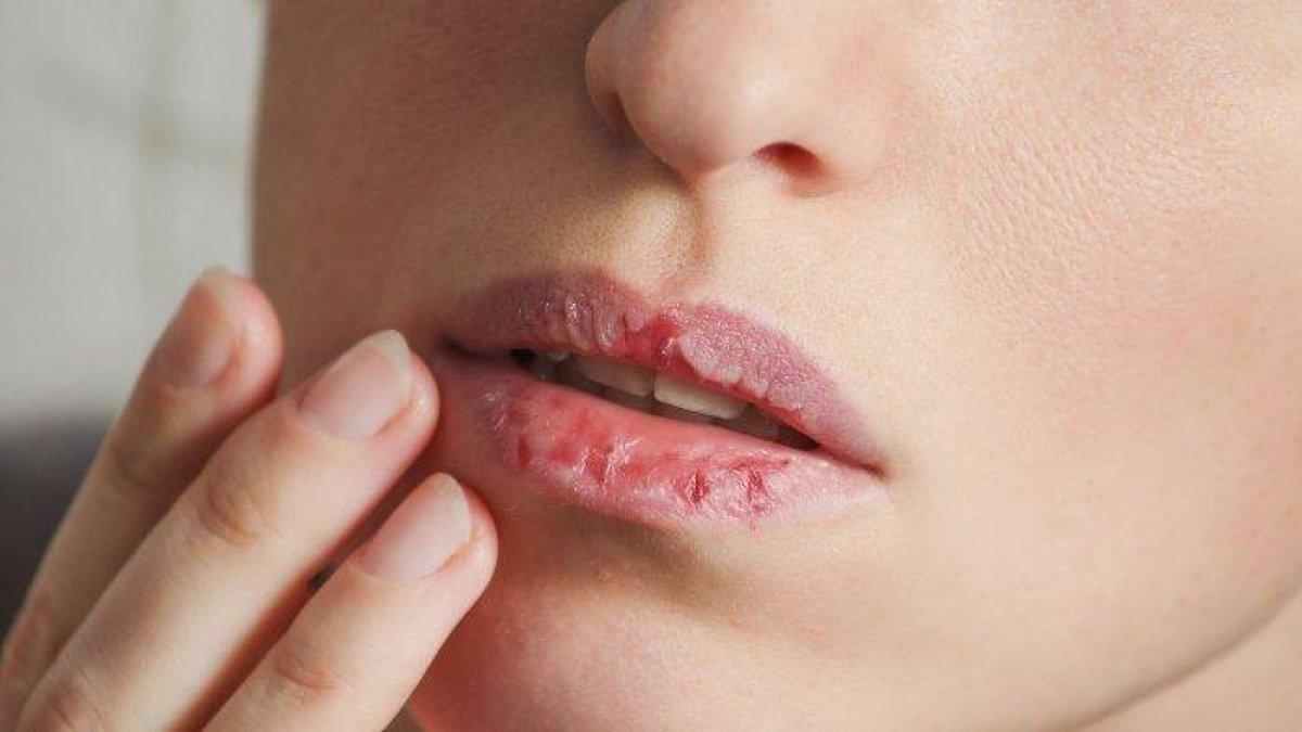 5 cara mengatasi bibir pecah-pecah secara alami