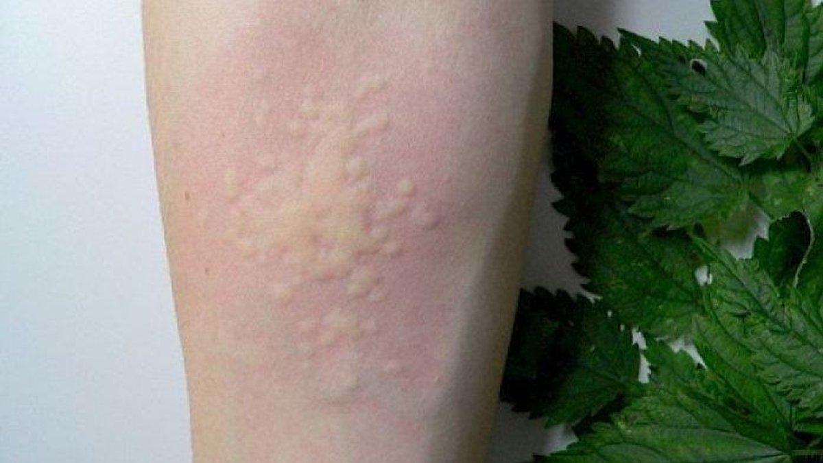 4 cara obati biduran secara alami