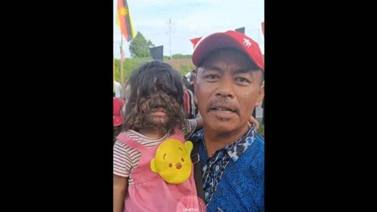 bocah 2 tahun bernama Adik Missclyen asal Malaysia alami hipertrikosis.