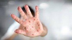 5 cara mengobati cacar air secara alami