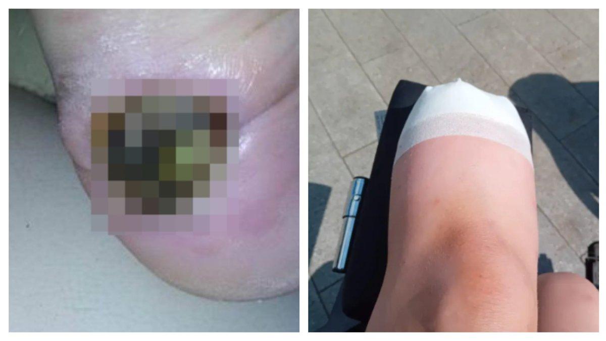 Charlie Beardshall-Moore, menceritakan pengalaman yang tidak akan pernah dilupakannya ketika kaki kirinya harus diamputasi.