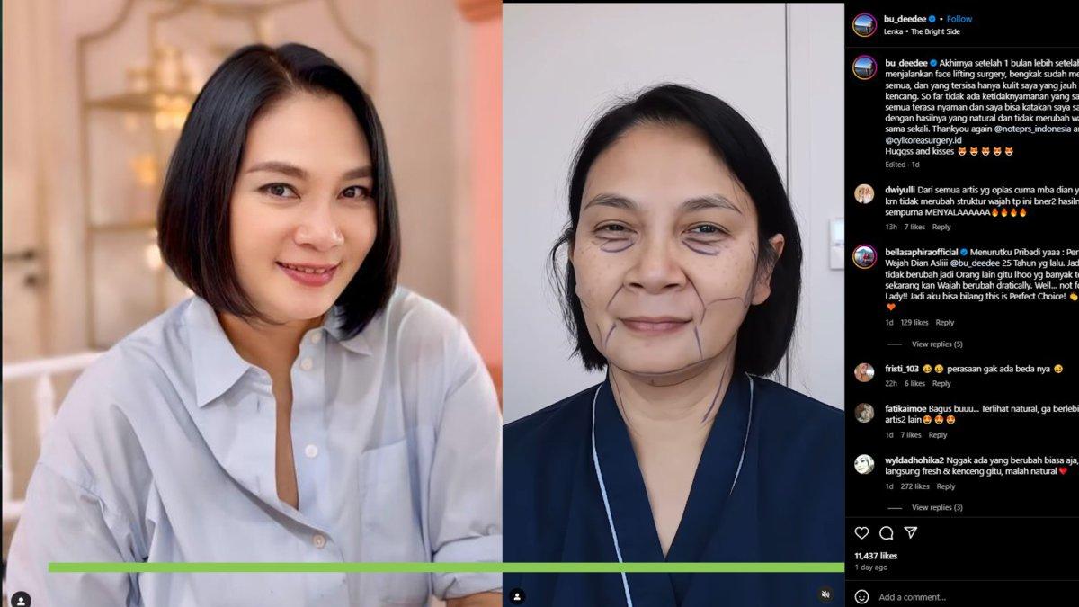 Pesona Dian Nitami Setelah Sebulan Oplas, kini Makin Cantik dan Awet Muda, Hasilnya Natural Banget