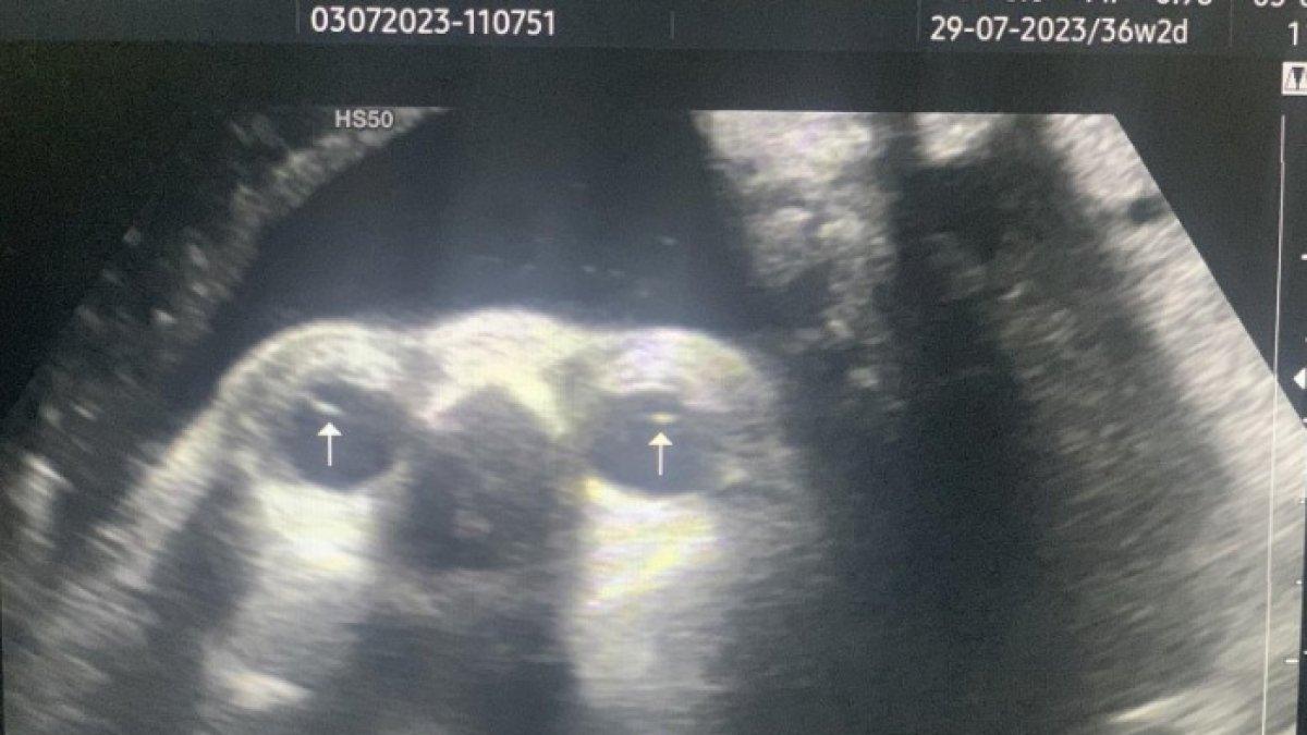 dr Giang Tien Trung dapati bayi yang dikandung A bermasalah pada bagian matanya