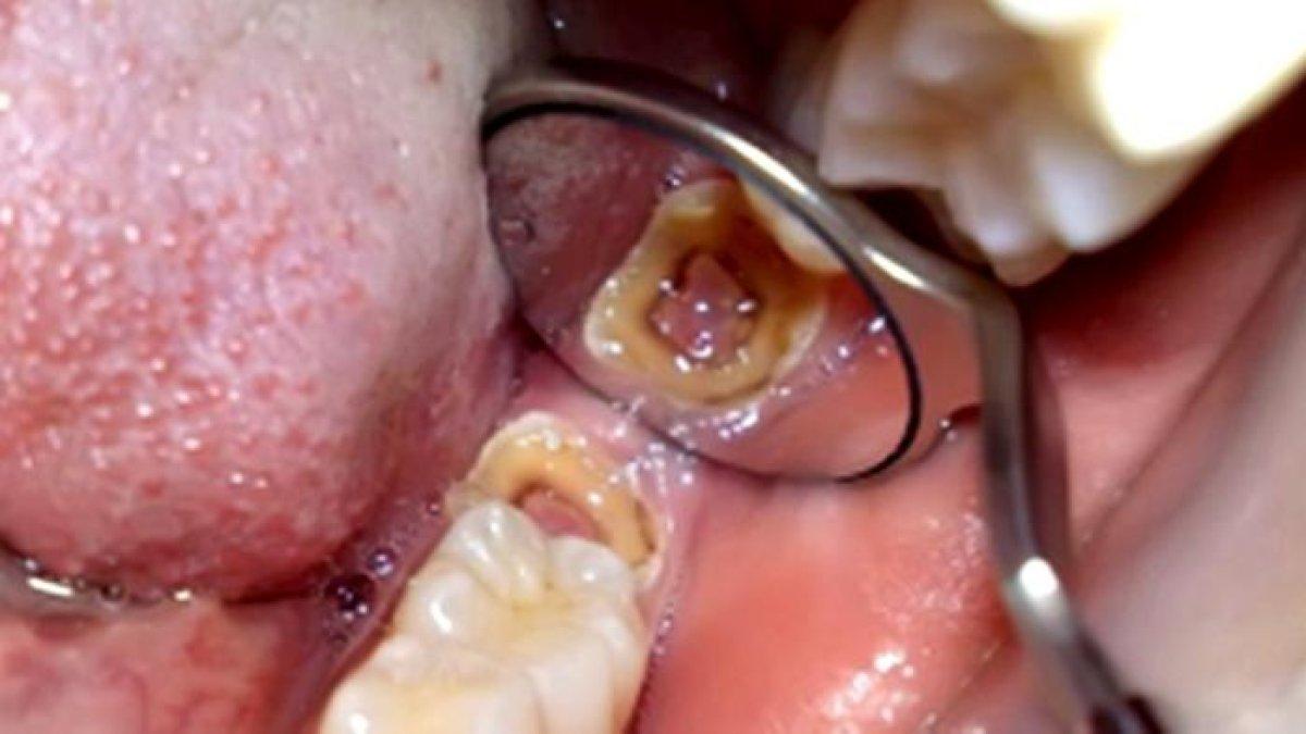 5 obat alami untuk mengobati gigi berlubang