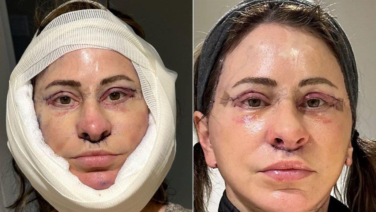 Kelly Beasley usai melakukan operasi untuk mengencangkan kulit wajahnya.