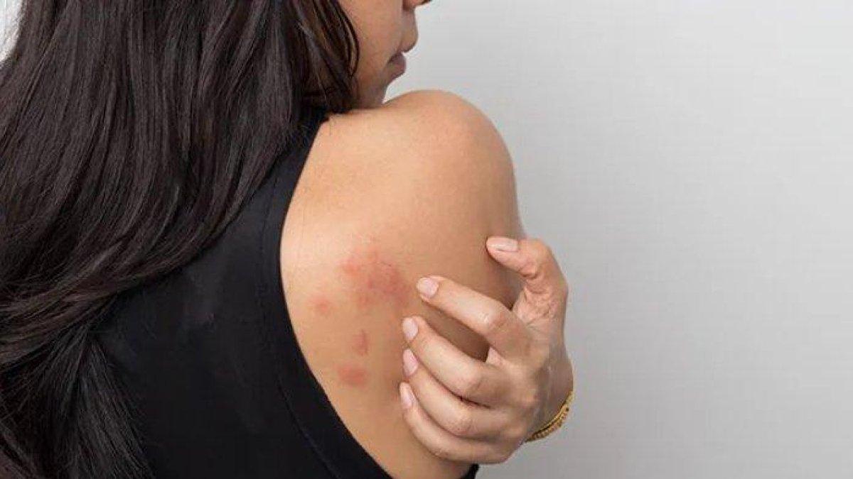 5 cara mengobati keringat buntet secara alami dengan bahan rumahan