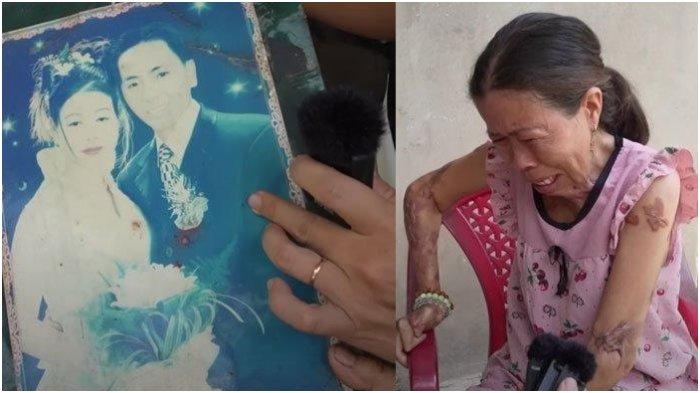 Nasib ibu tetiba idap penyakit langka usai melahirkan. Bintik-bintik di kulit kini saling menempel.